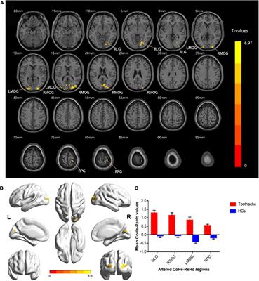 Altered regional homogeneity of spontaneous brain activity in patients with toothache: A resting-state functional magnetic resonance imaging study